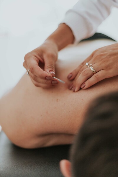 dry needling